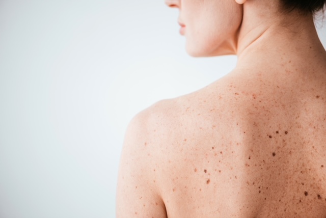  El cáncer a la piel se puede prevenir